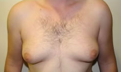 Typical Case of Man Boobs (Gynecomastia)