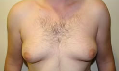 Typical Case of Man Boobs (Gynecomastia)