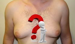 What is Gynecomastia?